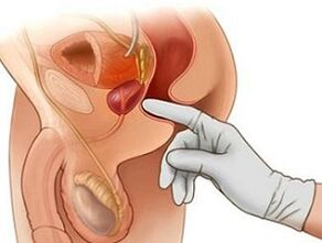 Prosztata masszázs a prosztatagyulladás kezelésére férfiaknál
