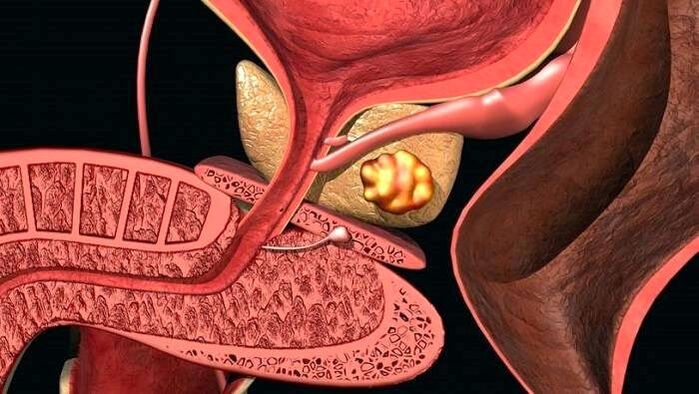 Kőlerakódások a prosztatában kalkulusos prosztatagyulladással