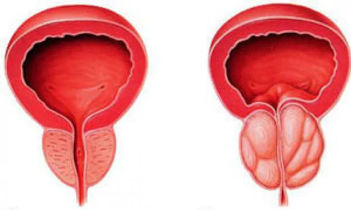 Normál prosztata (balra) és gyulladt krónikus prosztatagyulladás (jobbra)
